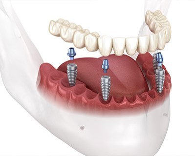 Treatmen image