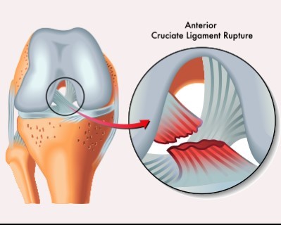 Anterior Cruciate Ligament (ACL) Reconstruction