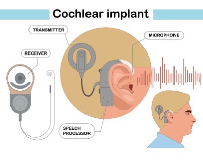 Cochlear Implant Surgery