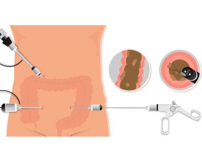 Colectomy