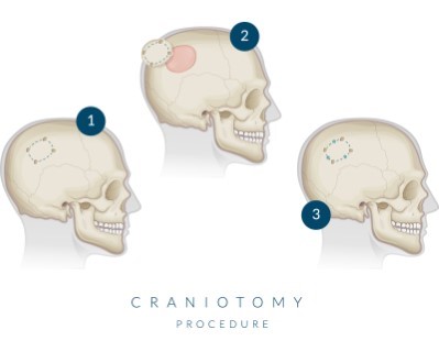 Treatmen image