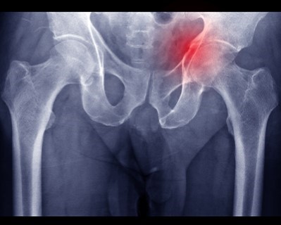 Hip Resurfacing