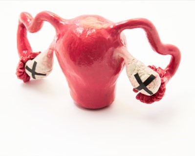 Laparoscopic Oophorectomy