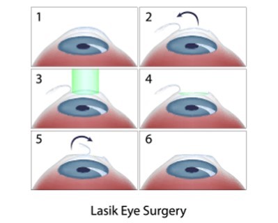 LASIK (Laser-Assisted In Situ Keratomileusis)
