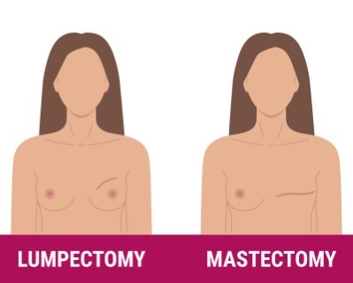 Mastectomy