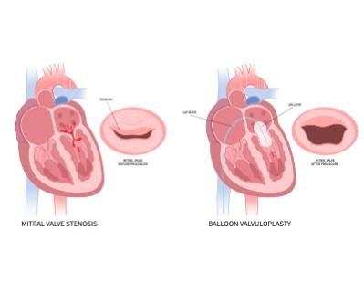 Treatmen image