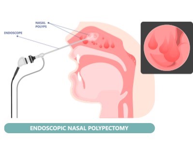 Nasal Polypectomy