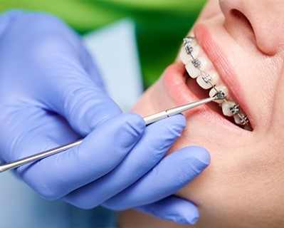 Orthodontic Treatment (Braces)