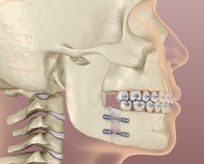 Orthognathic Surgery