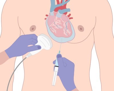 Pericardiocentesis