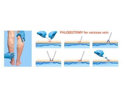 Phlebectomy (for Varicose Veins)