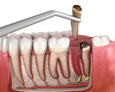Root Extraction