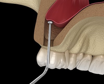 Sinus Lift