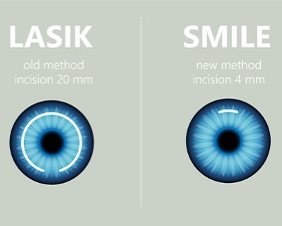 SMILE (Small Incision Lenticule Extraction)