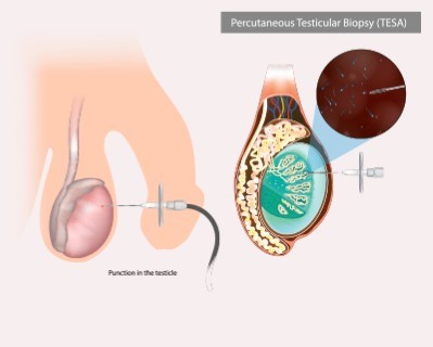 Testicular Sperm Extraction (TESE)