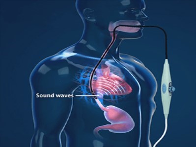 The Benefits and Process of Transesophageal Echocardiography (TEE)