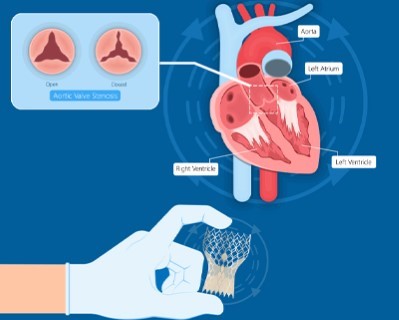 Transcatheter Aortic Valve Replacement (TAVR or TAVI)