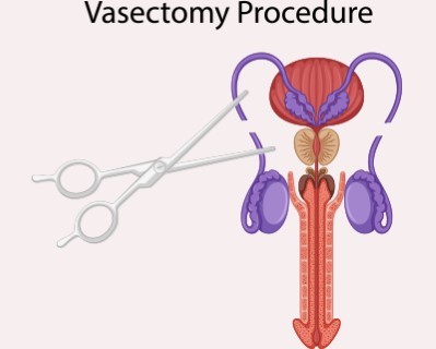 Vasectomy