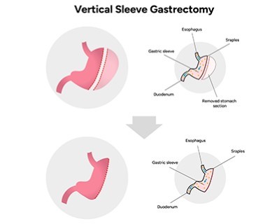 Vertical Sleeve Gastrectomy (VSG)